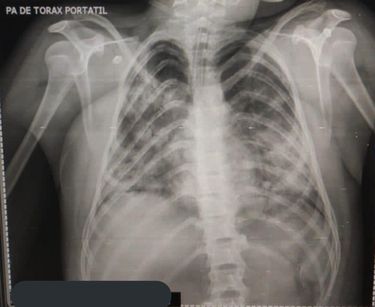 La radiografía de unos pulmones destapa covid-19 en adolescentes | Especial